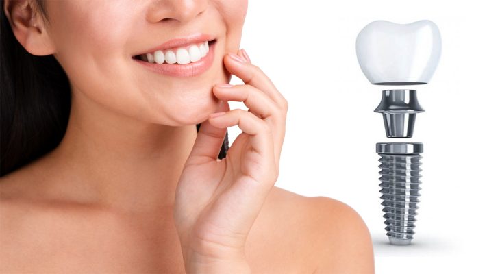 implant fiyatları 2025