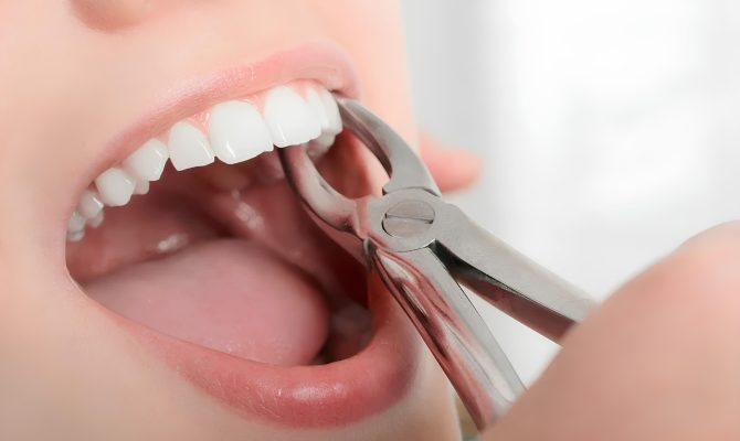 20 yaş diş çekimi